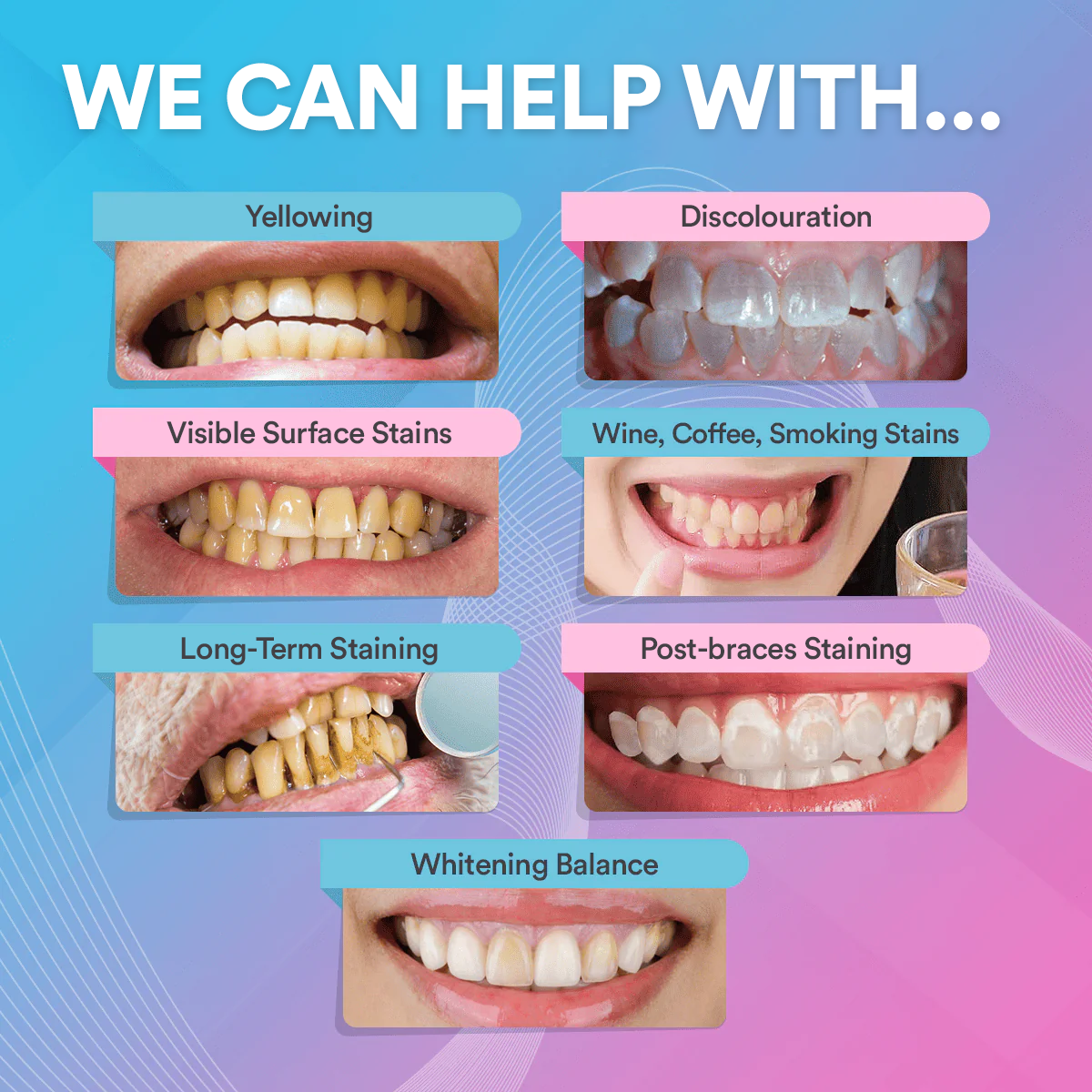 Advanced Teeth Whitening Strips (14 Treatments)